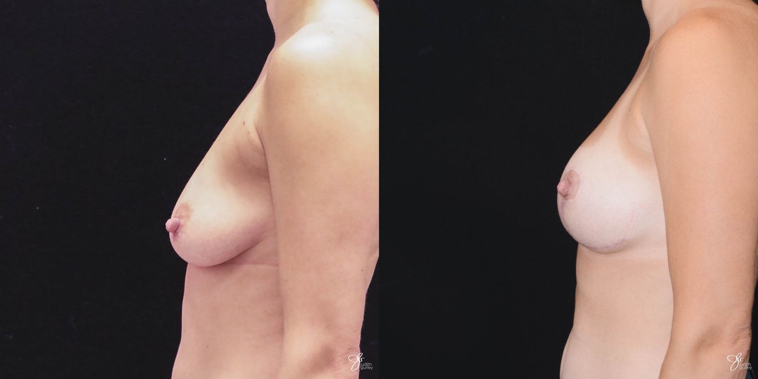 Breast Augmentation And Lift Before & After
