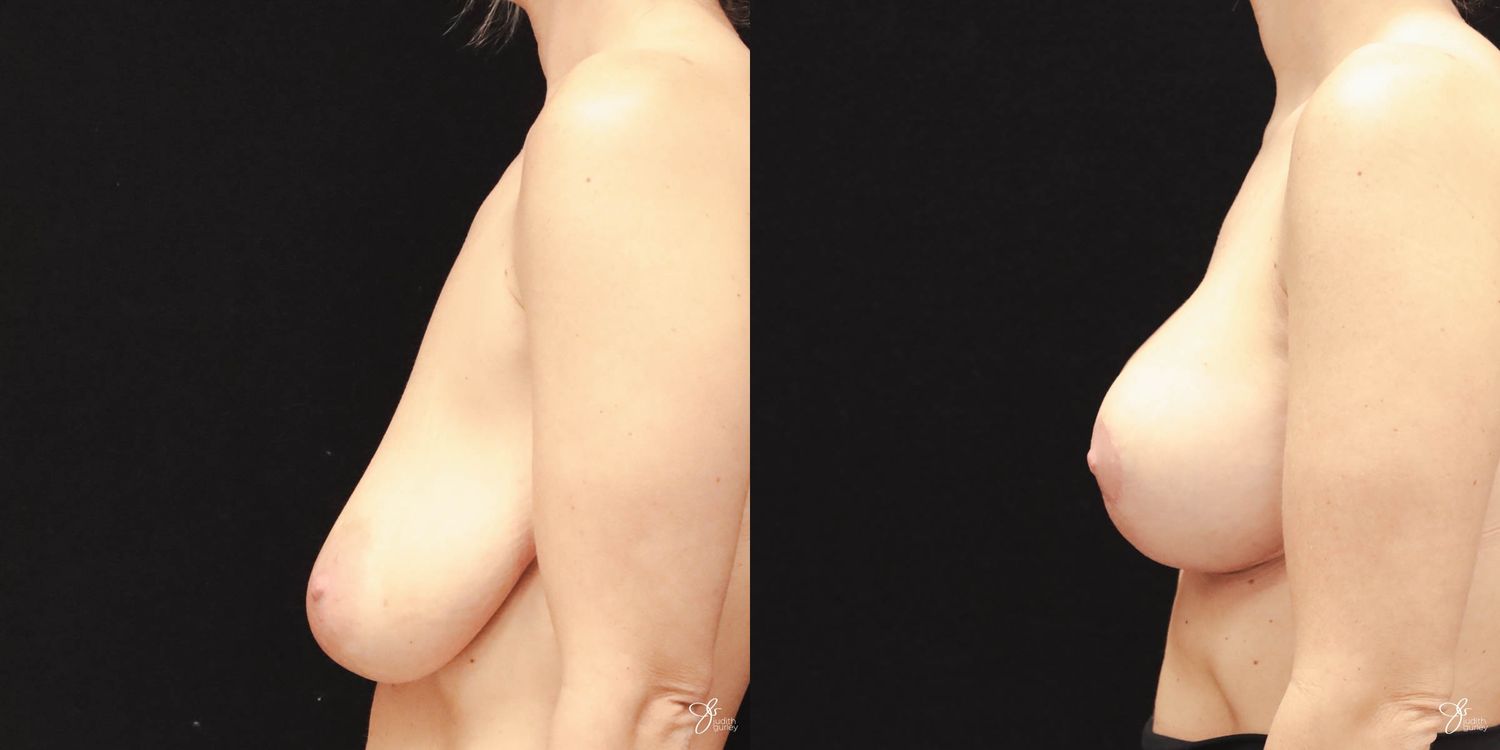 Breast Augmentation And Lift Before & After