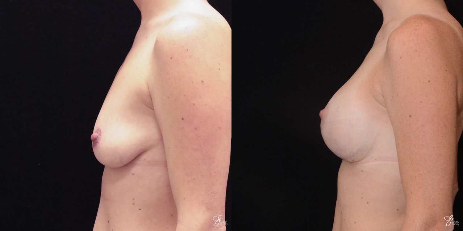 Breast Augmentation And Lift Before & After