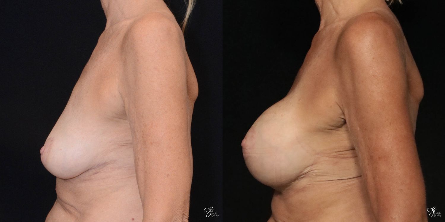 Breast Augmentation And Lift Before & After