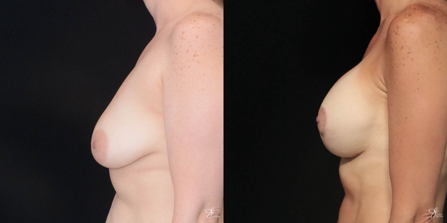 Breast Augmentation And Lift Before & After