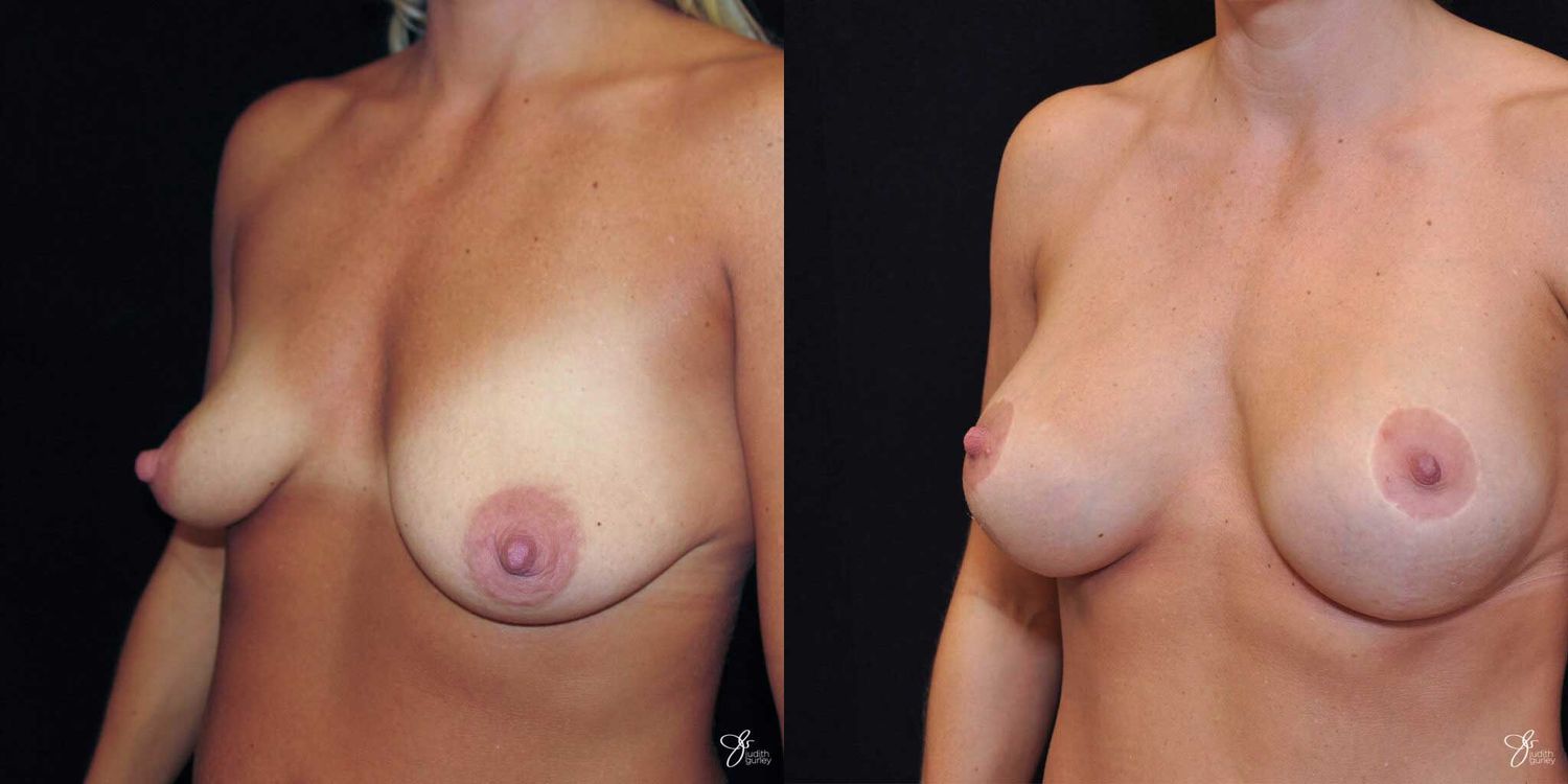 Breast Augmentation And Lift Before & After