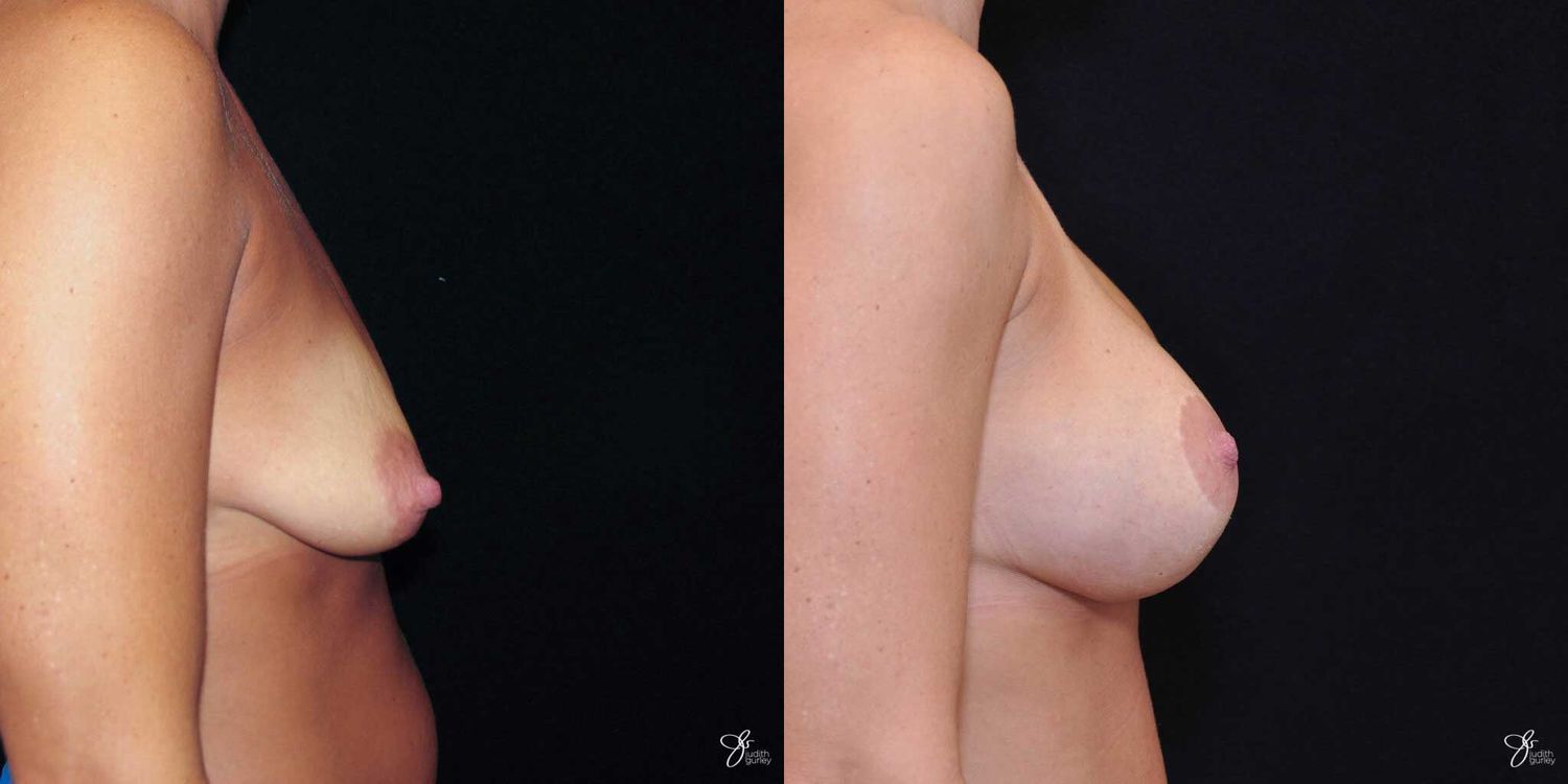 Breast Augmentation And Lift Before & After