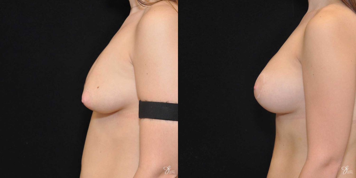 Breast Augmentation And Lift Before & After