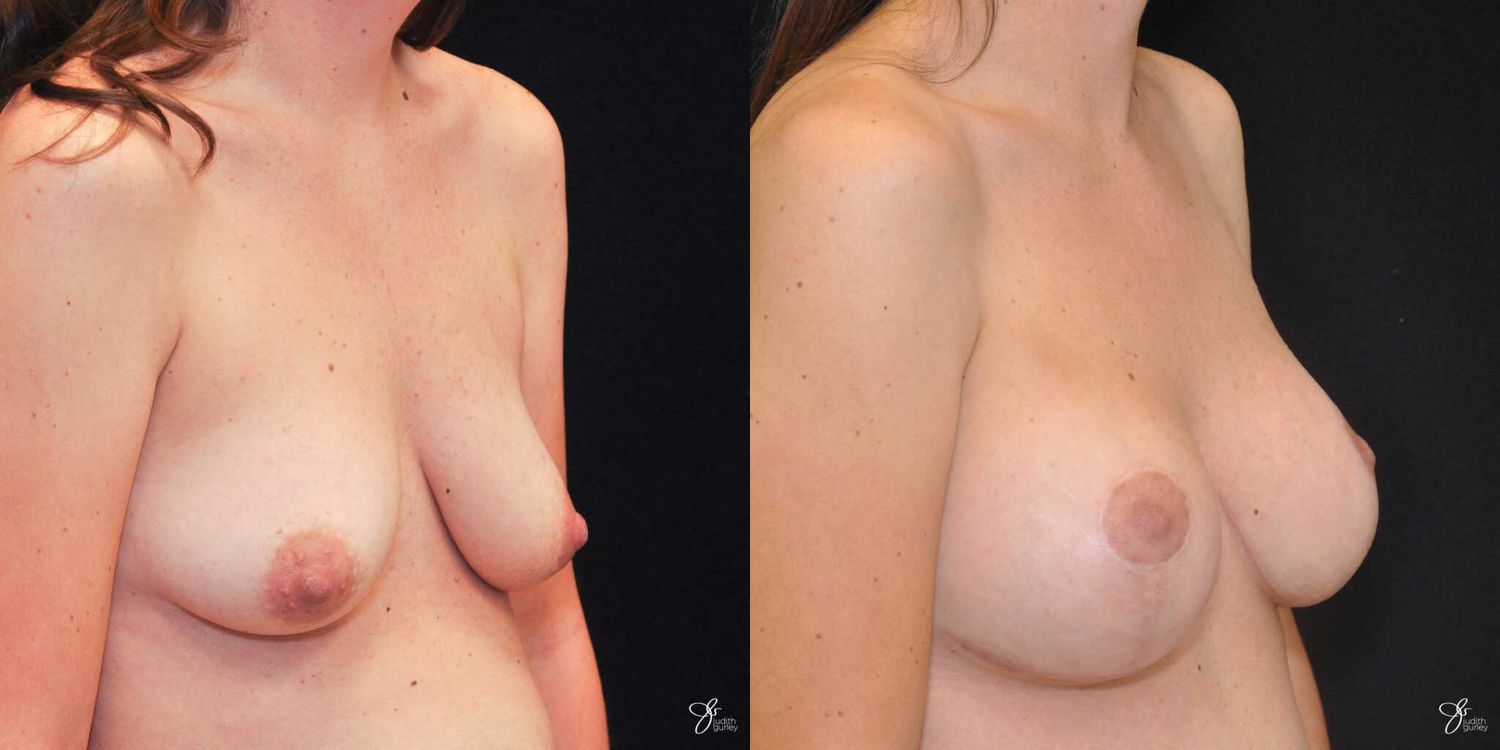 Breast Augmentation And Lift Before & After