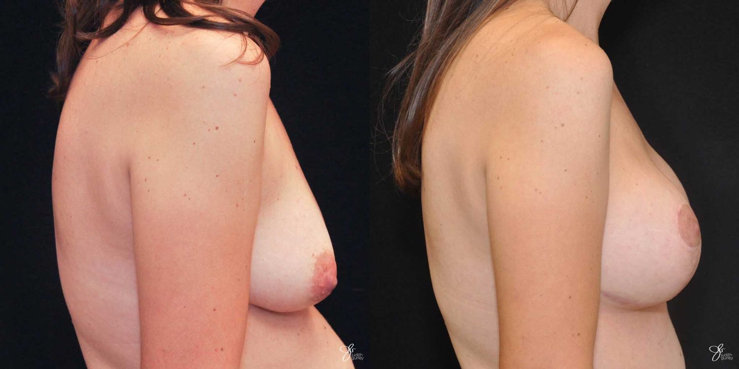Breast Augmentation And Lift Before & After