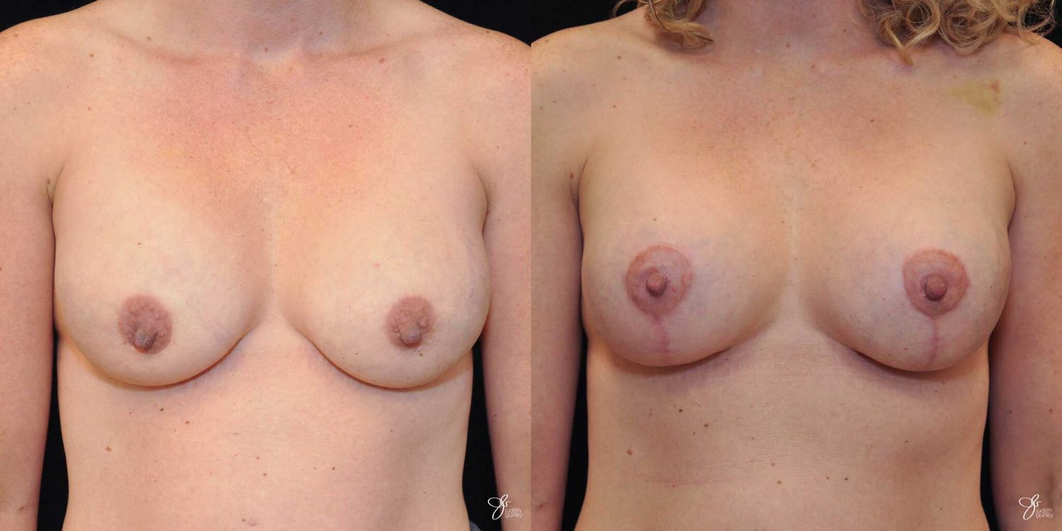 Breast Augmentation And Lift Before & After