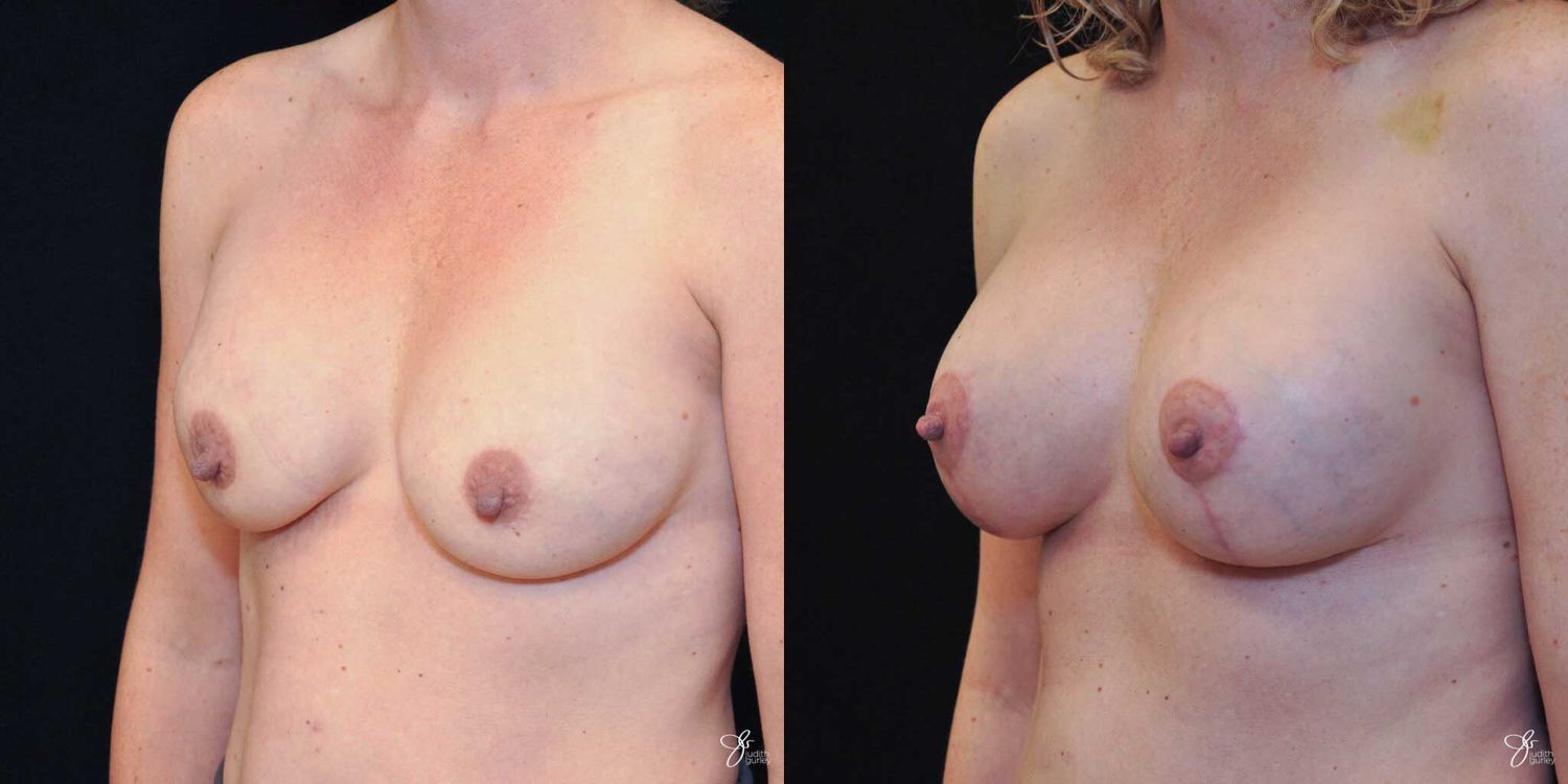 Breast Augmentation And Lift Before & After
