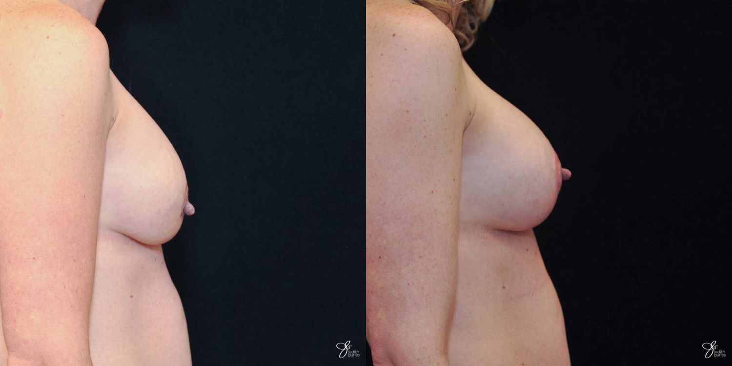 Breast Augmentation And Lift Before & After