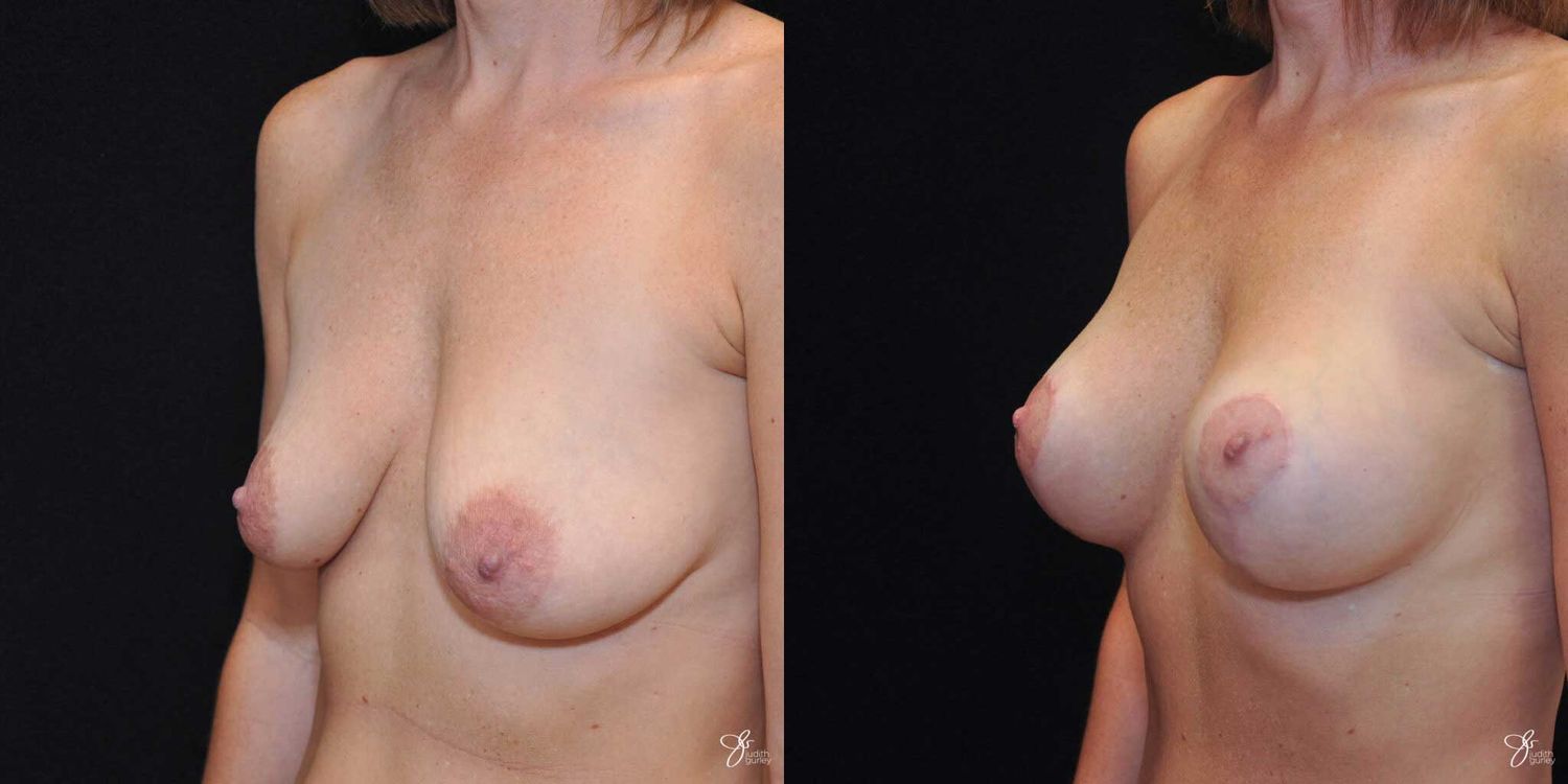 Breast Augmentation And Lift Before & After