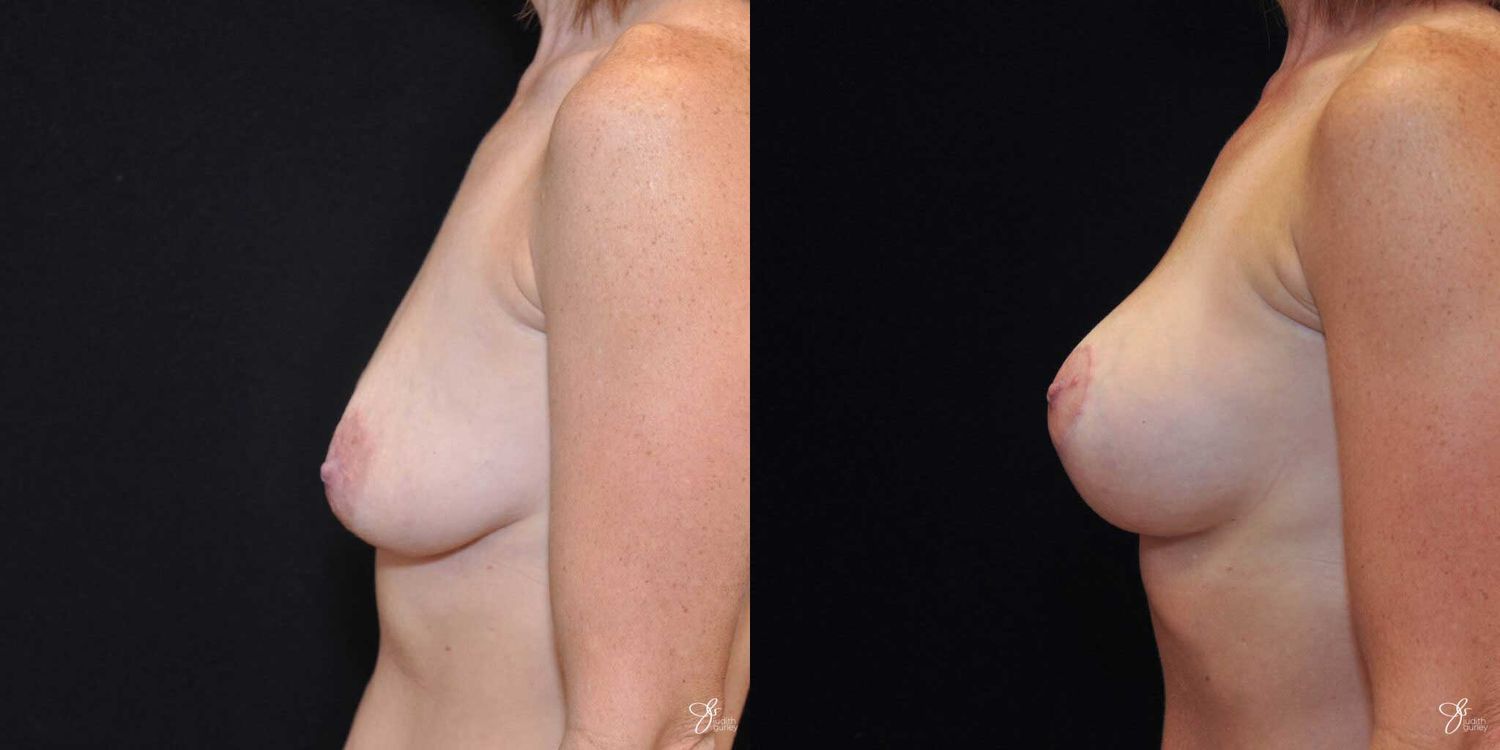 Breast Augmentation And Lift Before & After