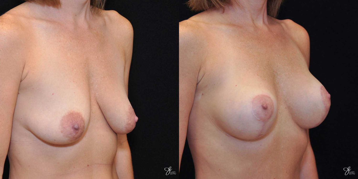 Breast Augmentation And Lift Before & After