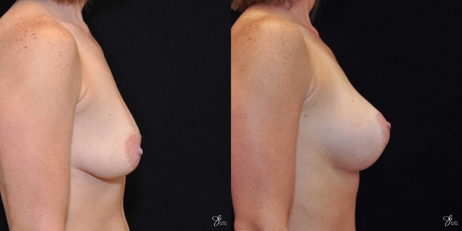 Breast Augmentation And Lift Before & After