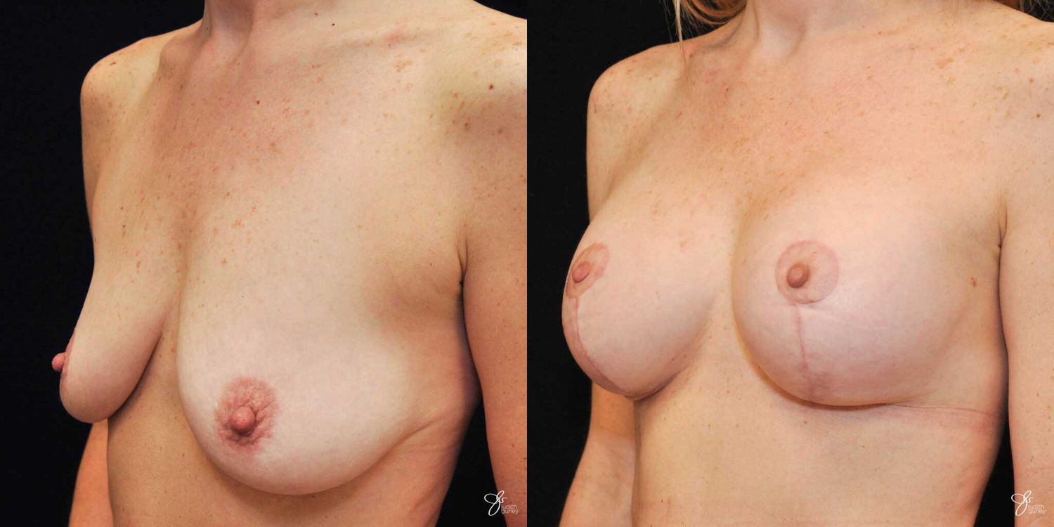 Breast Augmentation And Lift Before & After