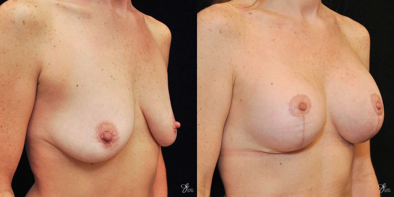 Breast Augmentation And Lift Before & After