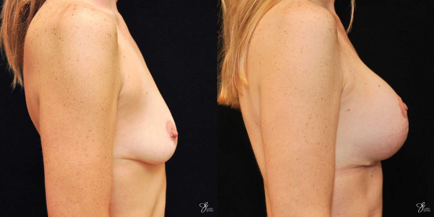 Breast Augmentation And Lift Before & After