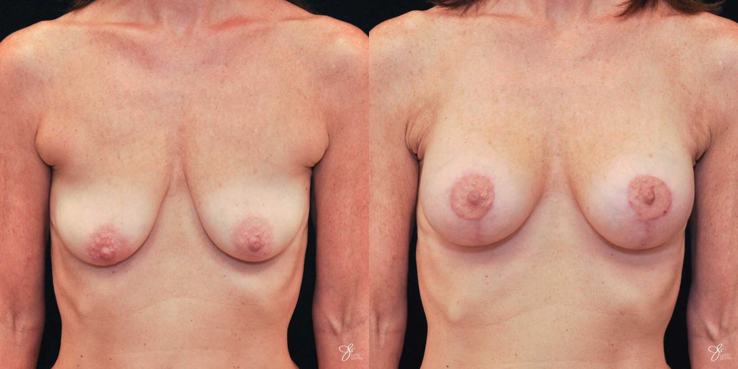 Breast Augmentation And Lift Before & After