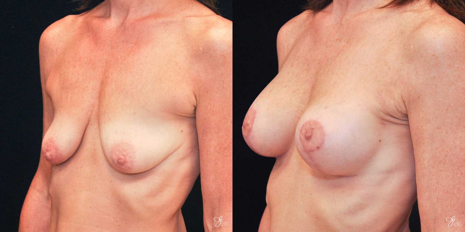 Breast Augmentation And Lift Before & After