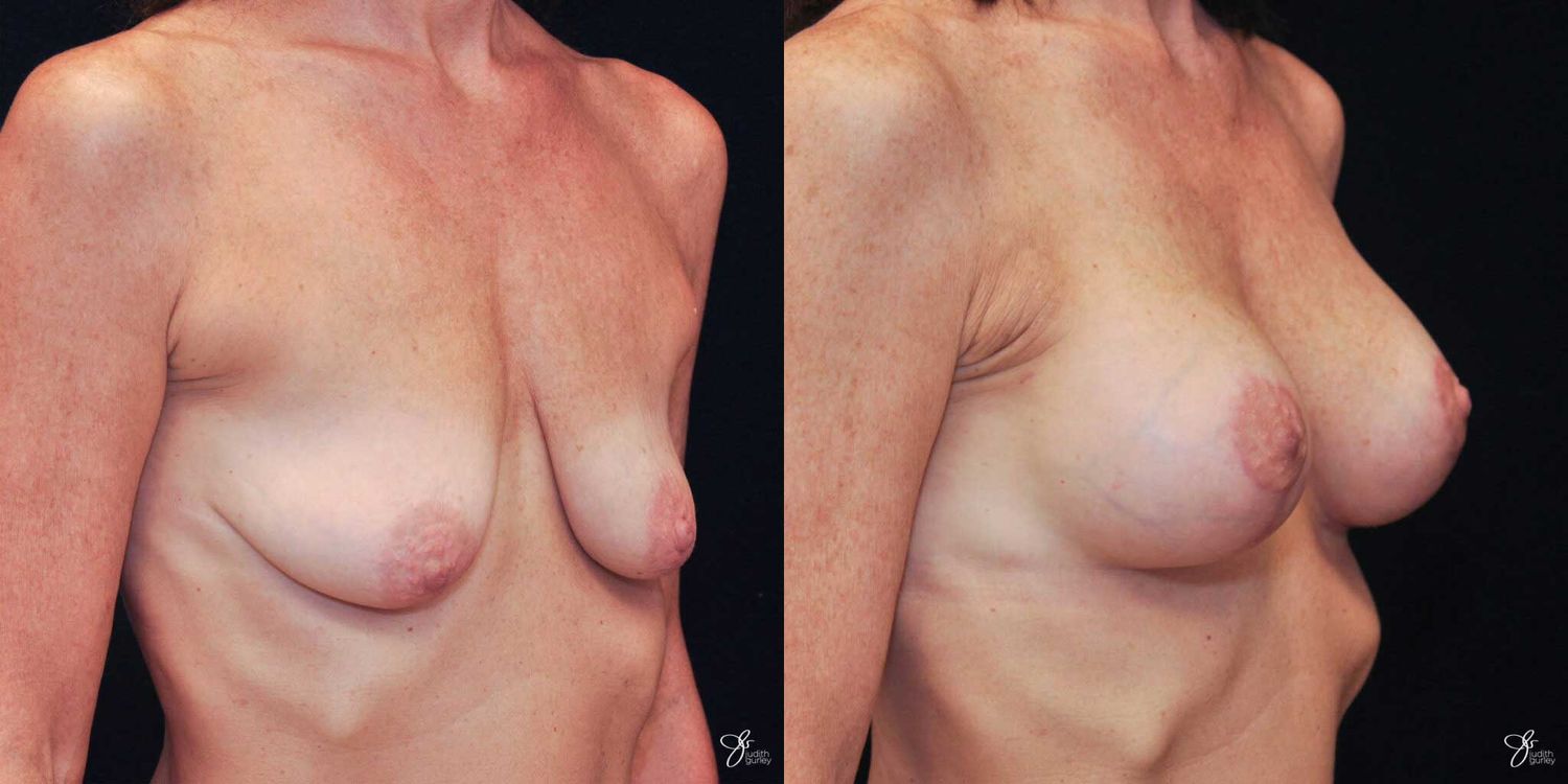 Breast Augmentation And Lift Before & After