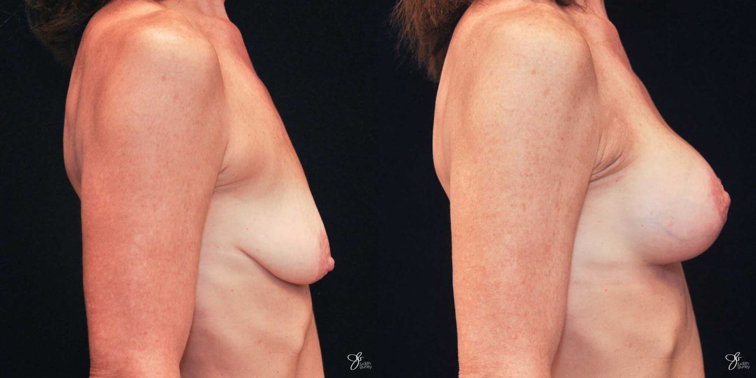 Breast Augmentation And Lift Before & After