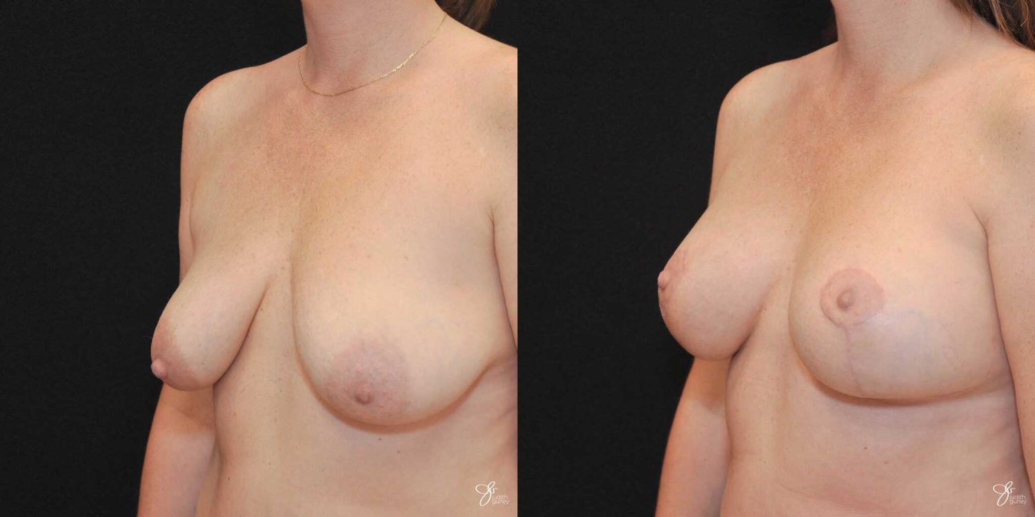 Breast Augmentation And Lift Before & After