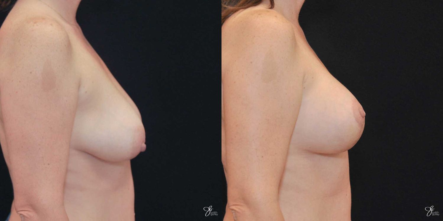 Breast Augmentation And Lift Before & After
