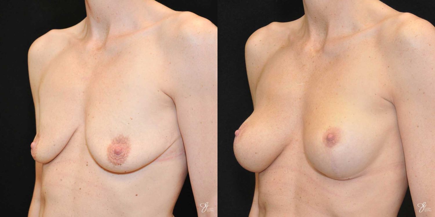 Breast Augmentation And Lift Before & After