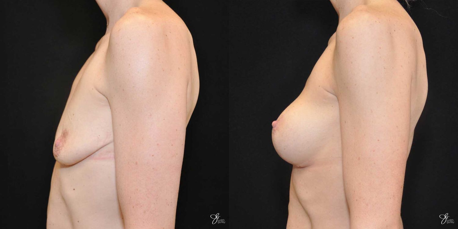 Breast Augmentation And Lift Before & After
