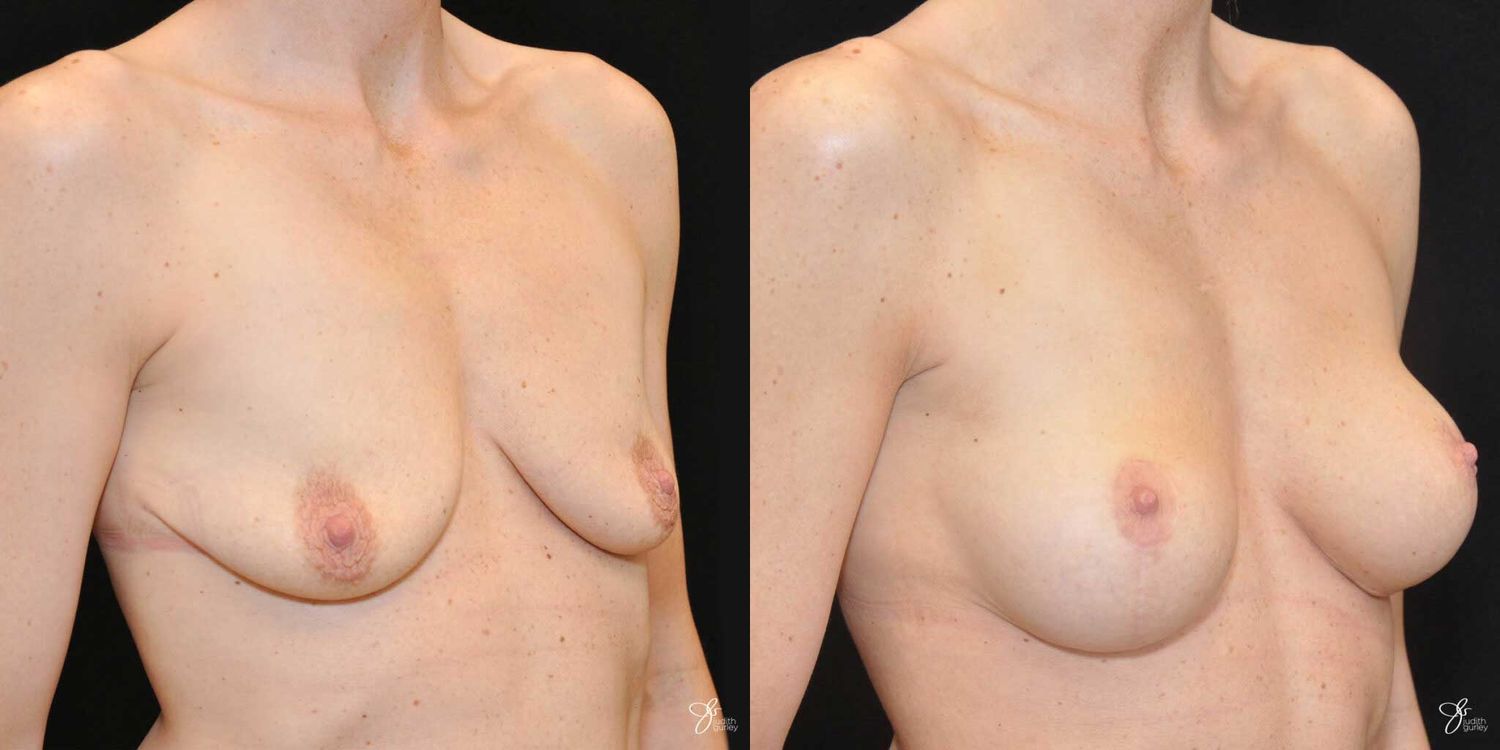 Breast Augmentation And Lift Before & After