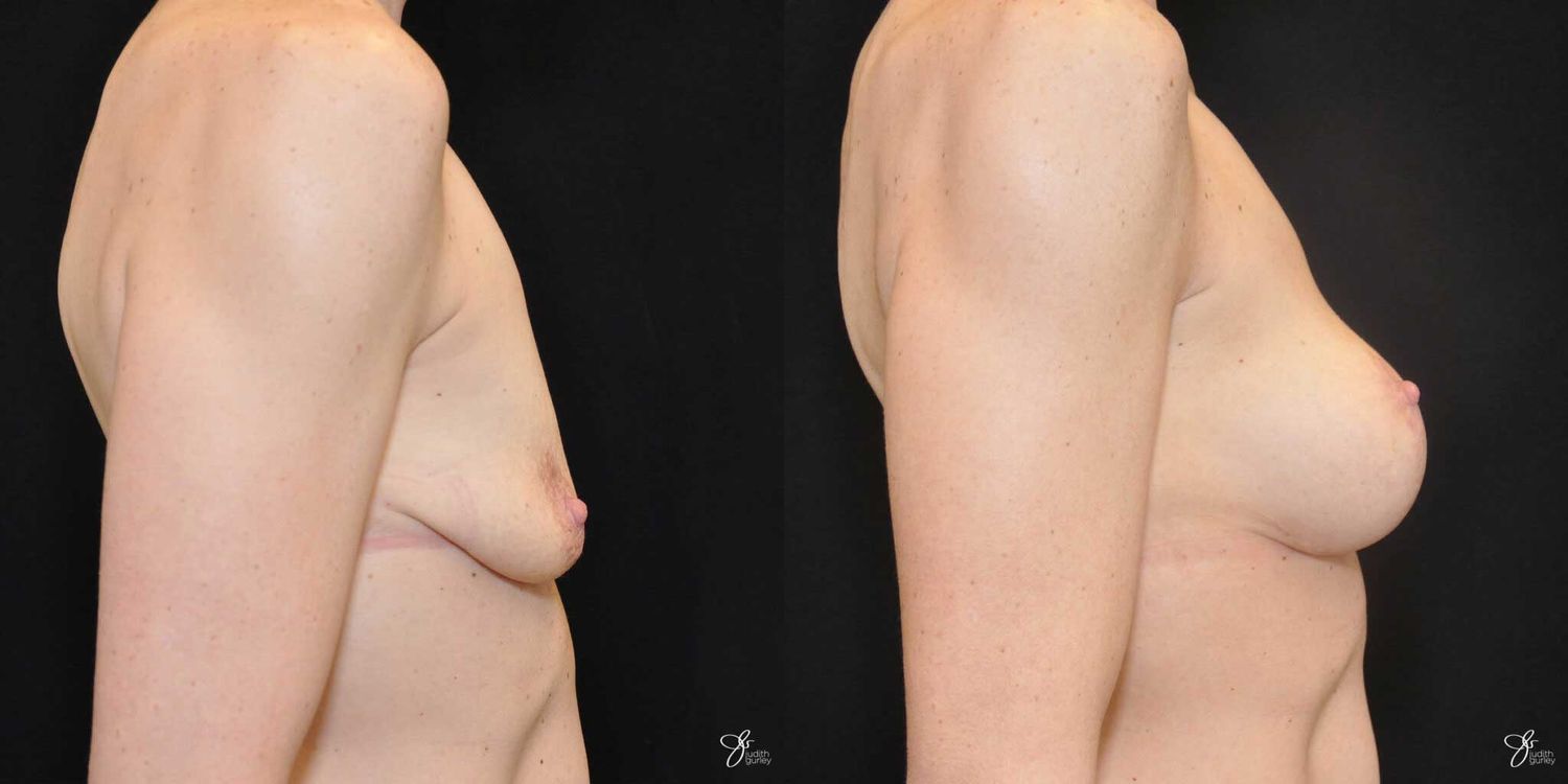 Breast Augmentation And Lift Before & After