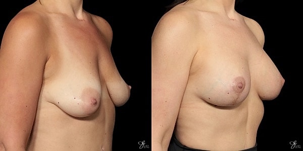 Breast Augmentation And Lift Before & After