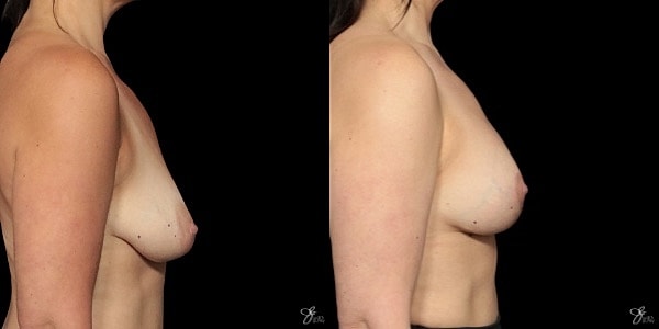 Breast Augmentation And Lift Before & After