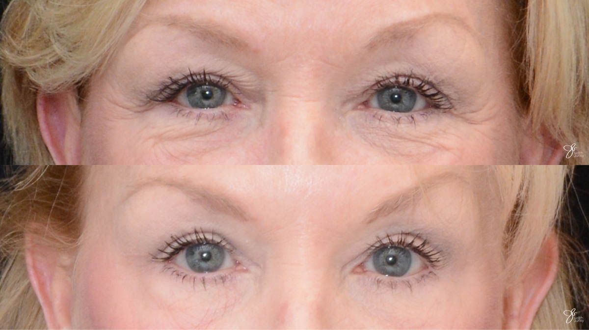 Eyelid Lift Before & After