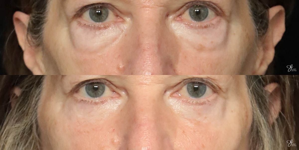 Eyelid Lift Before & After