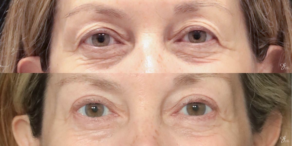 Eyelid Lift Before & After