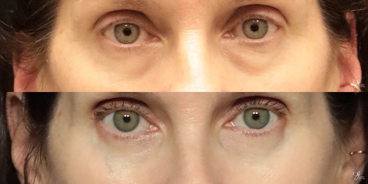 Eyelid Lift Before & After