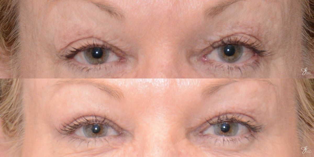 Eyelid Lift Before & After