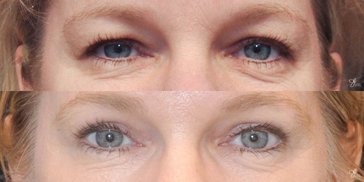 Eyelid Lift Before & After