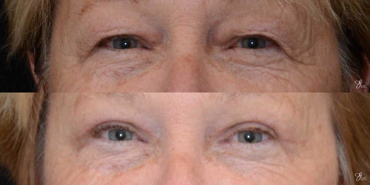 Eyelid Lift Before & After