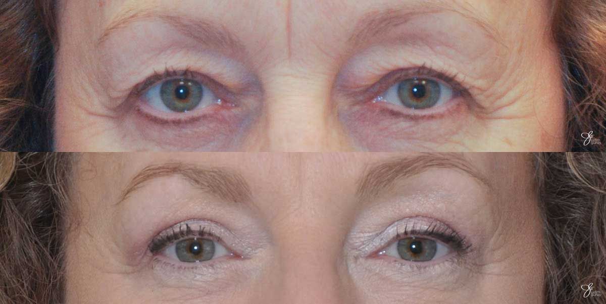 Eyelid Lift Before & After