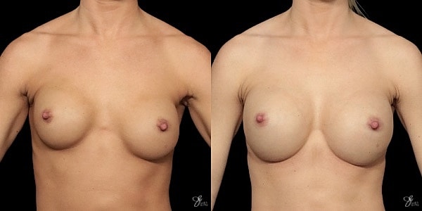 Implant Removal Replacement Before & After