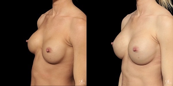 Implant Removal Replacement Before & After