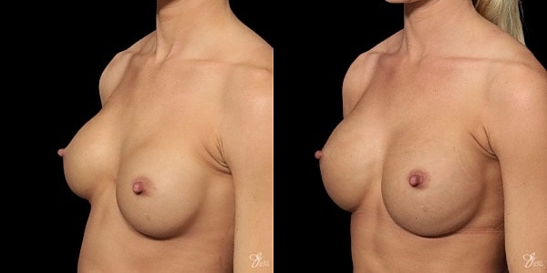 Implant Removal Replacement Before & After