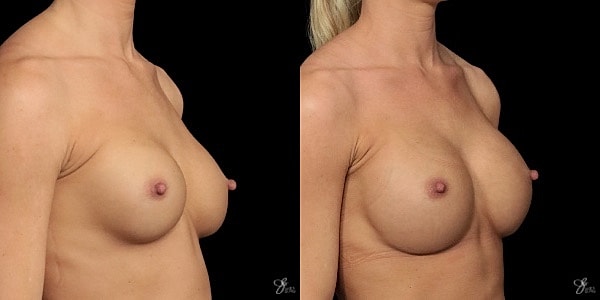 Implant Removal Replacement Before & After