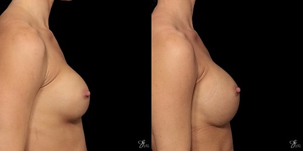 Implant Removal Replacement Before & After