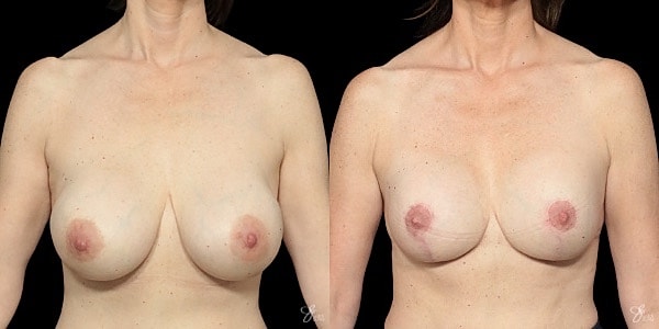 Implant Removal Replacement Before & After