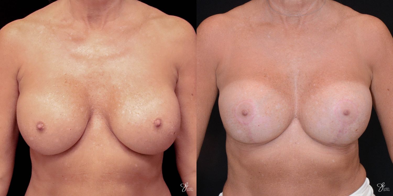 Implant Removal Replacement Before & After