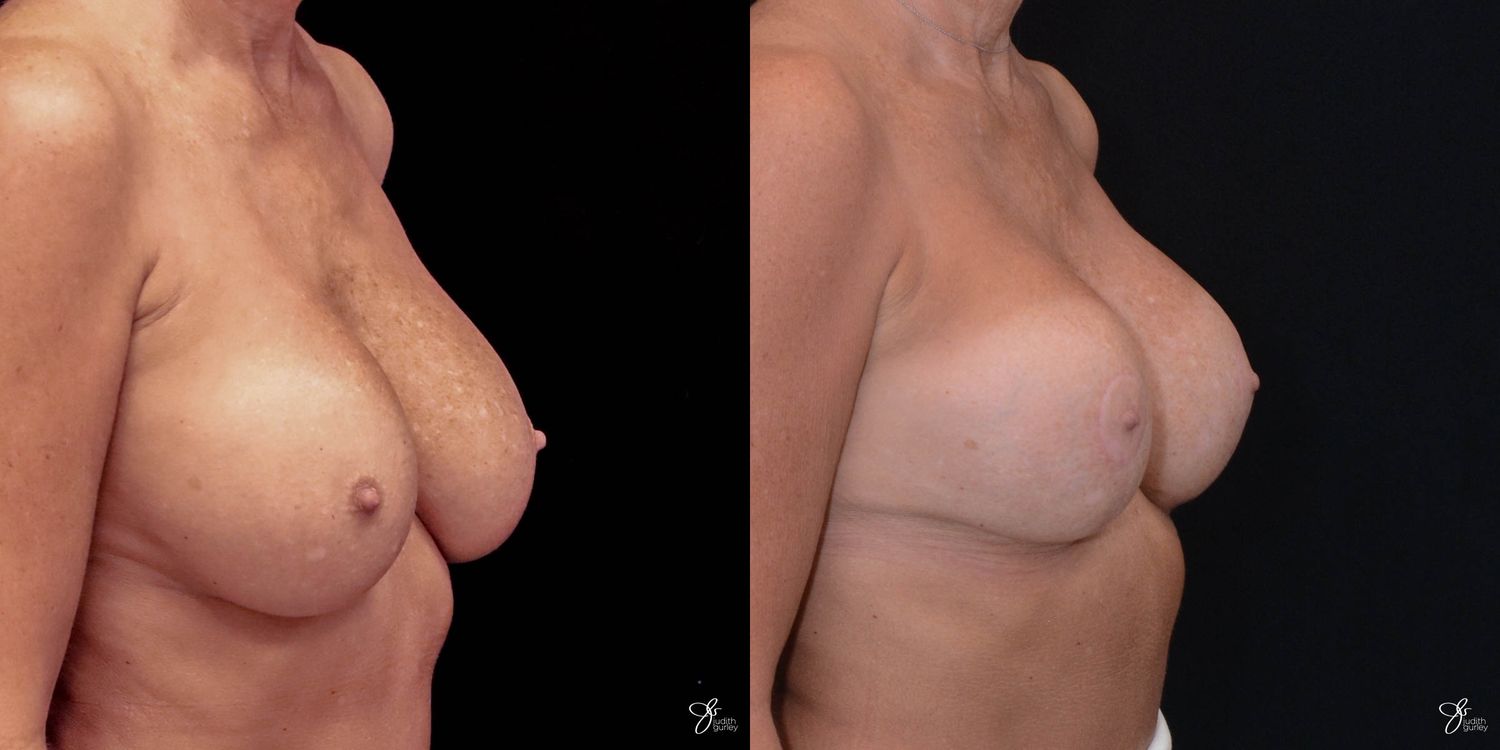 Implant Removal Replacement Before & After