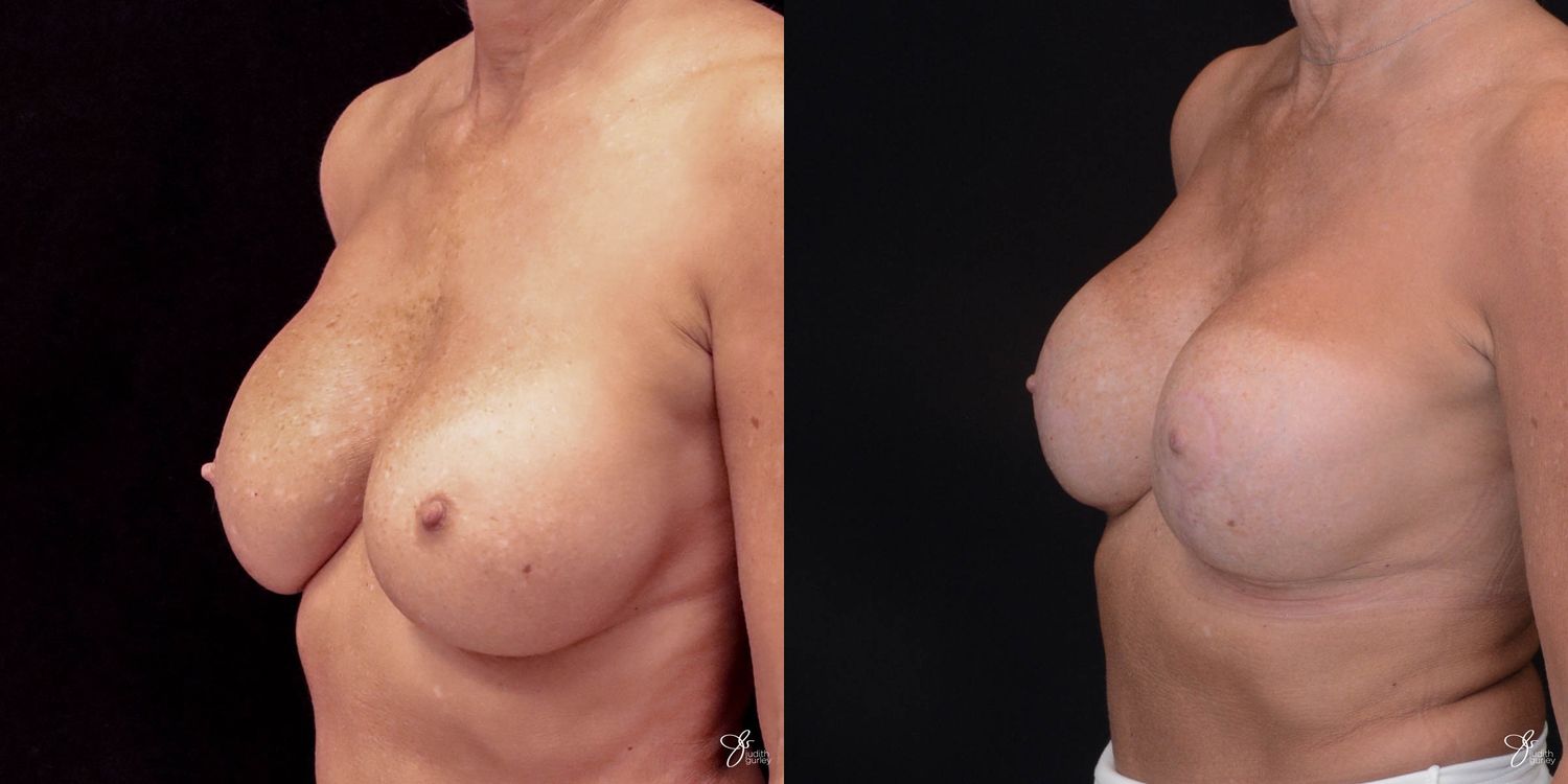 Implant Removal Replacement Before & After