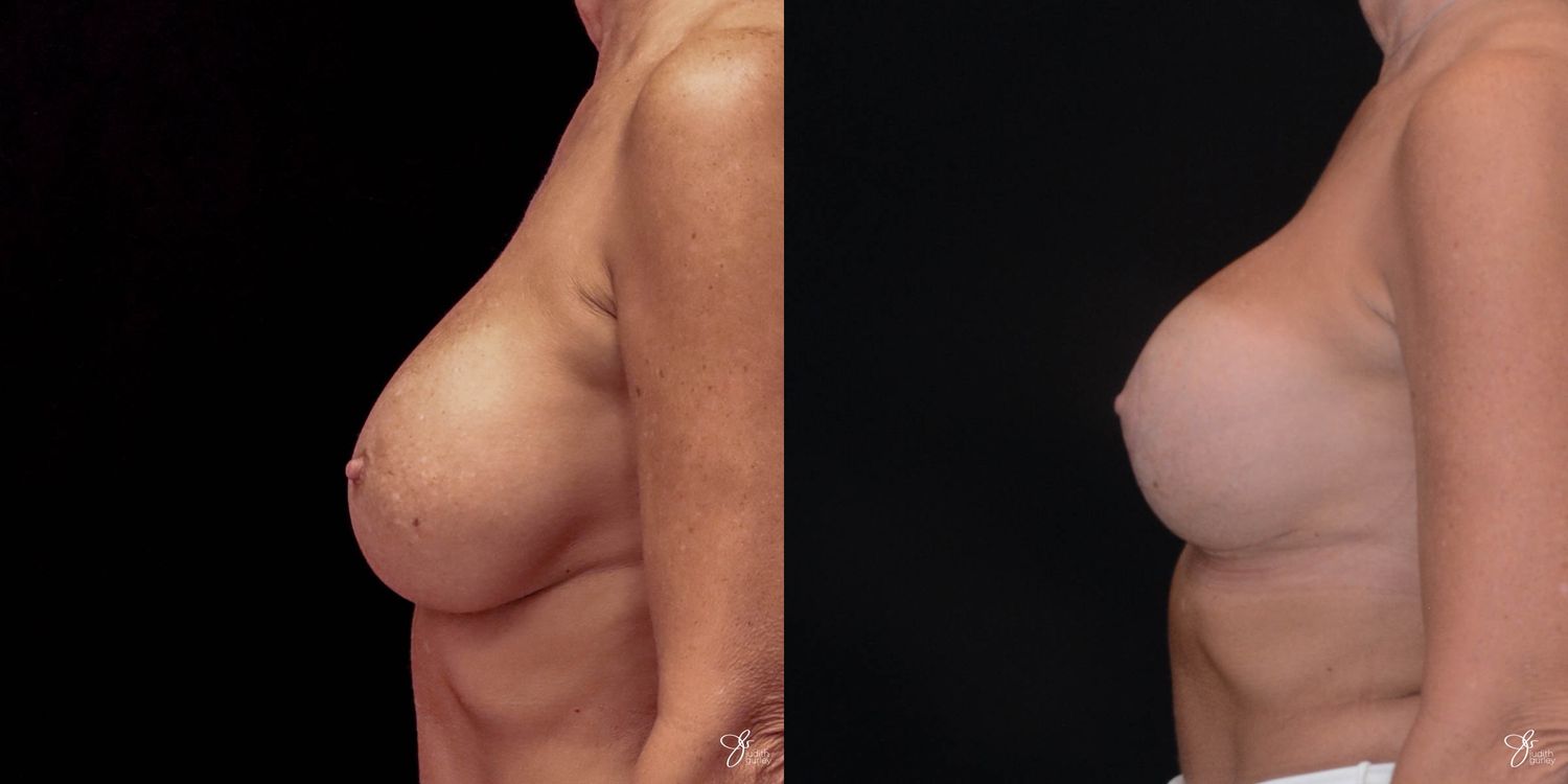 Implant Removal Replacement Before & After